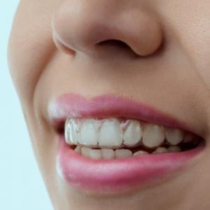 Ortodoncia - Dentistas en Móstoles